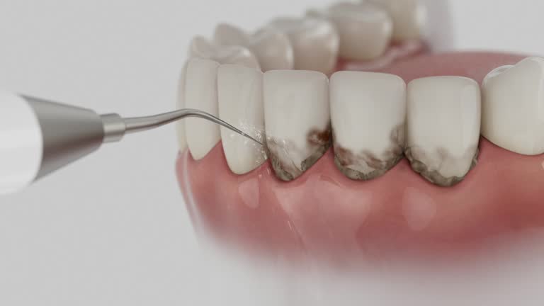 Trusted Wisdom Tooth Removal service in Covington, KY - Dentist Open Now